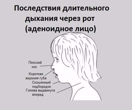 Изменение профиля лица при  носовом дыхании.