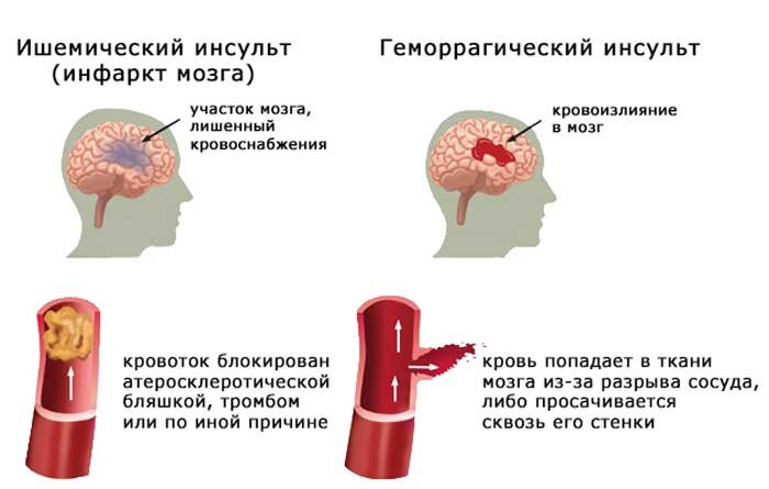 Нарушение мозгового кровообращения - Ксаврон