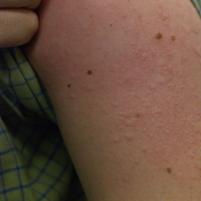 Сначала на коже высыпают маленькие красные волдыри, которые очень хочется почесать (как после укуса комара или ожога крапивой) 