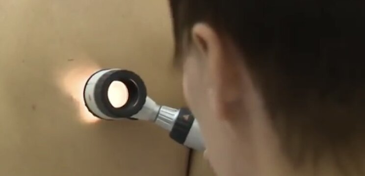 Как распознать опасные родинки?