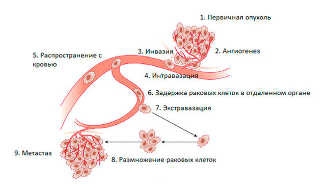 Механизм матастазирования злокачественной опухоли. Гемангиома - не метастазирует!