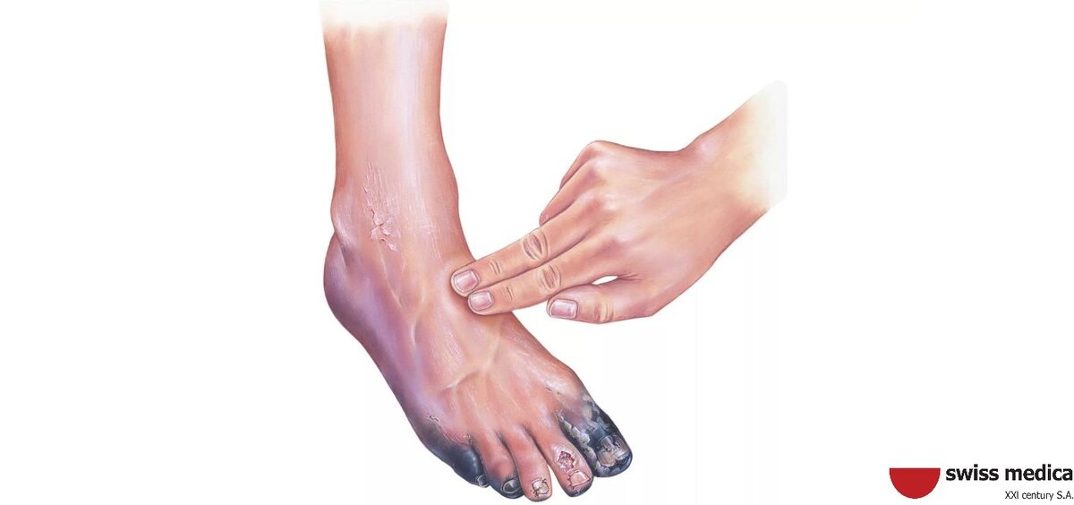 Диабетическая стопа