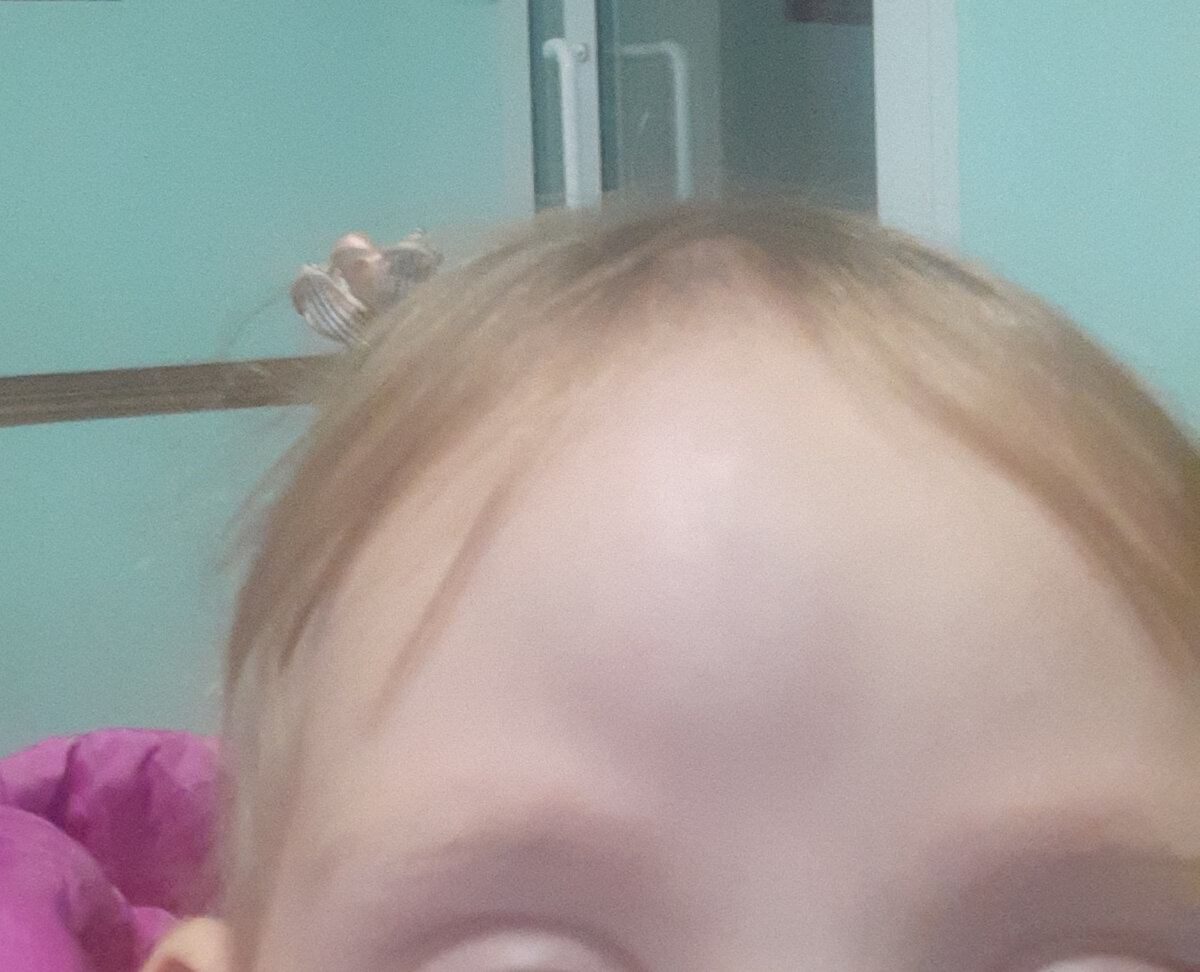 Перед рентгеном. Уже не так страшно. Сдулась немного.