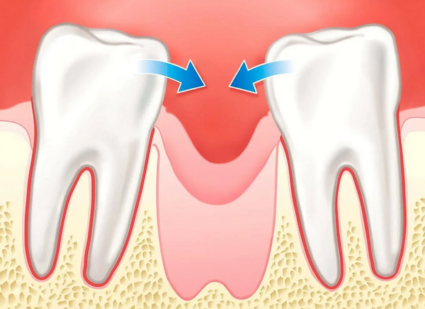 Cu o absență îndelungată a dintelui, vecinii săi sunt deplasați.  Acest fenomen în stomatologie se numește efect Popov-Godon.