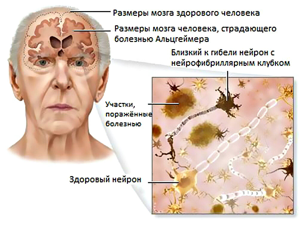 Сенильные бляшки при болезни Альцгеймера