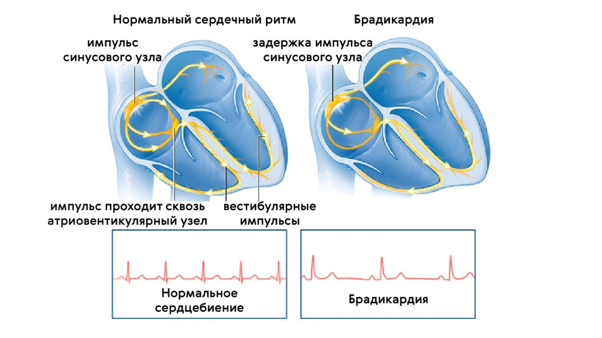 Синусовая брадикардия сердца