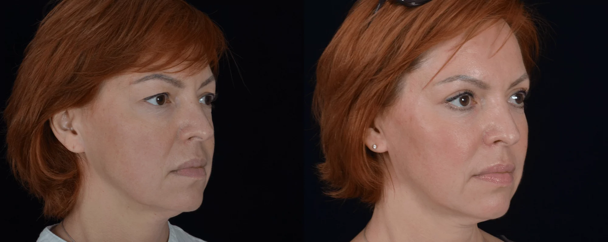 Липофилинг лица и пластика верхних век фото до и после. Фото с сайта Д.Р. Гришкяна. Имеются противопоказания, требуется консультация специалиста