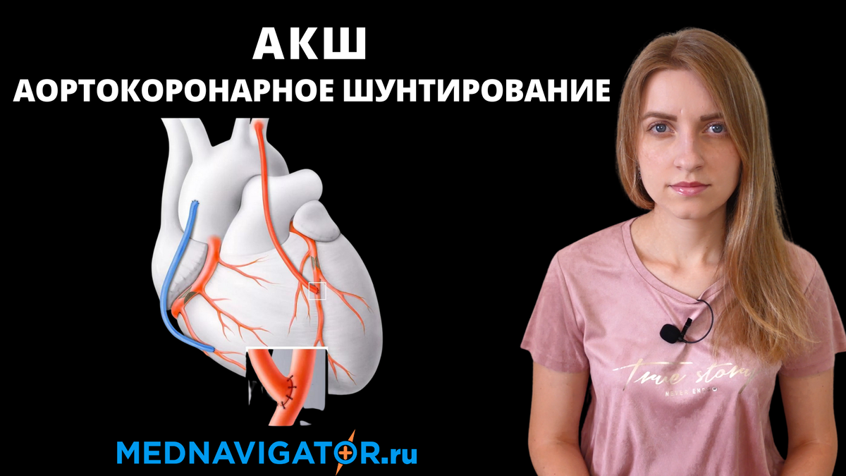 АКШ - аортокоронарное шунтирование | Лечение ИБС (ишемической болезни ...