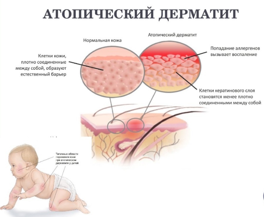 Симптомы атопического дерматита
