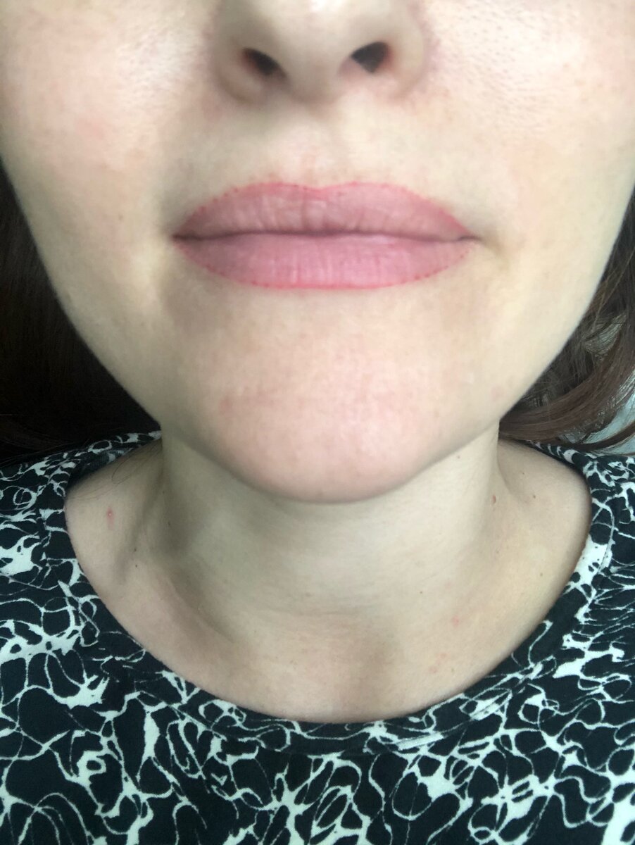 губы перед процедурой; фото клиента