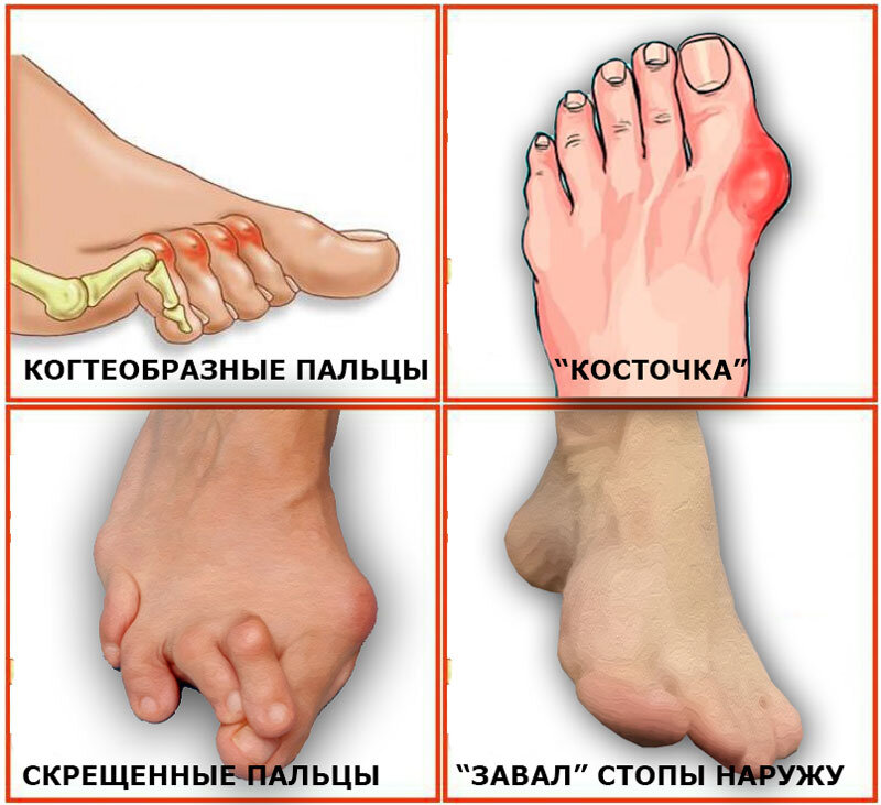 Воспалилась и болит косточка на ноге у большого пальца, что делать?