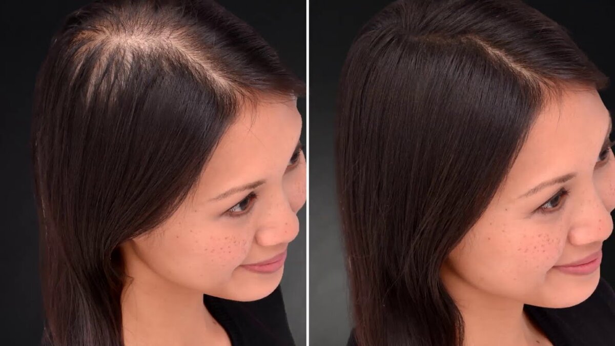 Что делать женщинам, если сильно сыпятся волосы?(