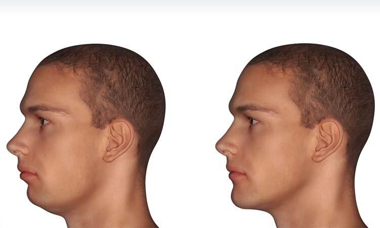 Как уменьшить массивную нижнюю челюсть с помощью хирургической операции | Vogue | Vogue Russia