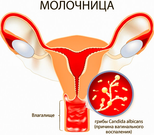 Причина молочницы - избыточное размножение Candida albicans