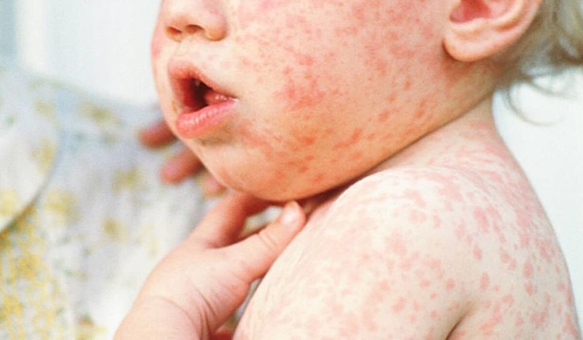 внезапная экзантема