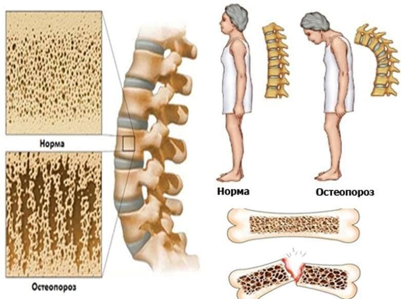 Остеопороз – это болезнь, при которой кости становятся хрупкими. 