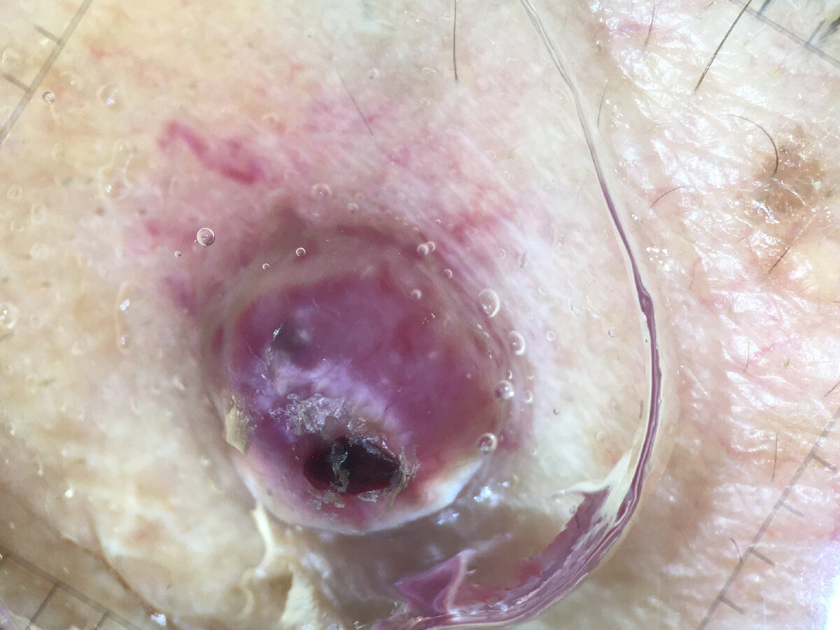 Тот же элемент. Дерматоскопия.