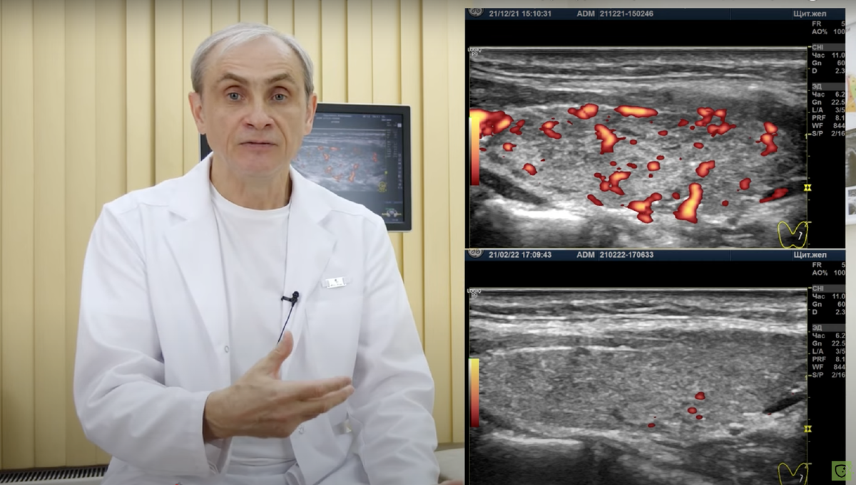 Доктор Ушаков (кадр из фильма). Восстановление структуры и напряжения (по кровотоку) в левой доле щитовидной железы (на снимках - даты и параметры настроек)