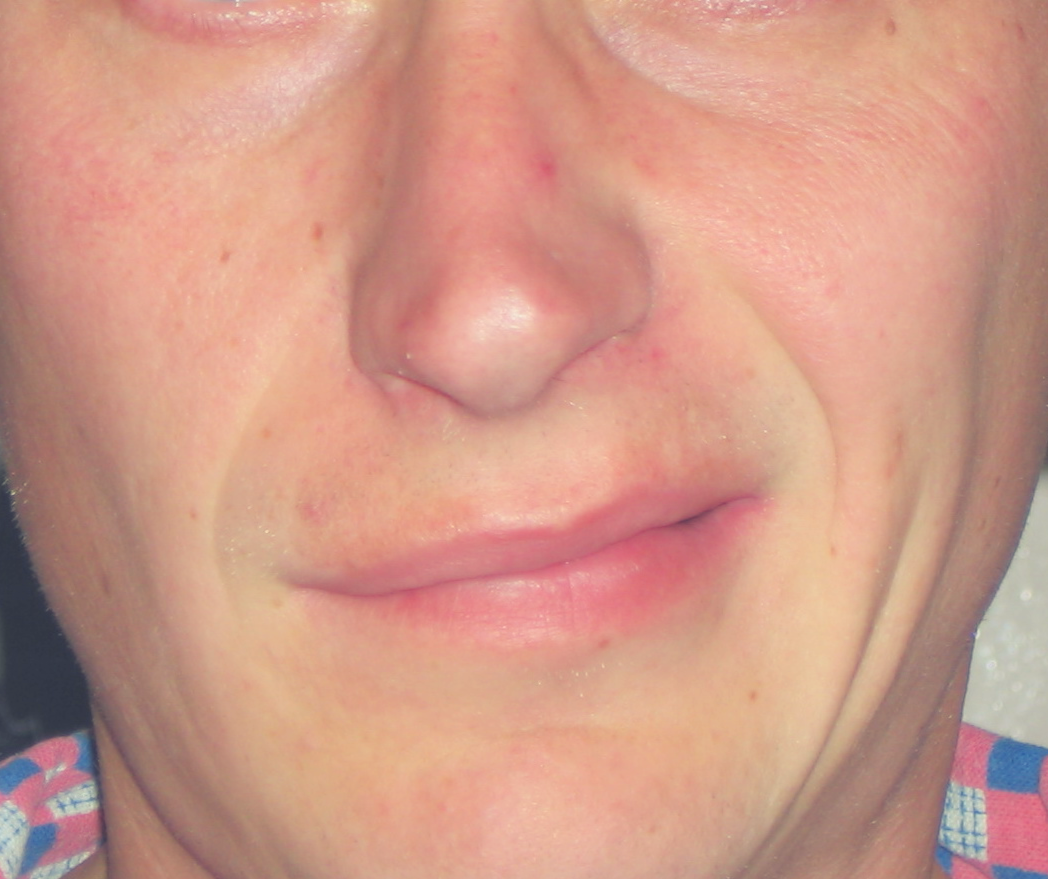 Парез лицевого нерва