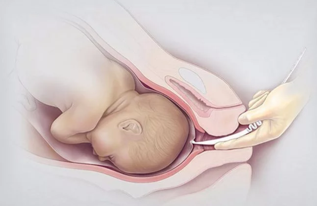 Вызывающие роды 40 недель беременности. Амниотомия многоводие. Амниотомия Акушерство. Прокол пузыря амниотомия плодного.