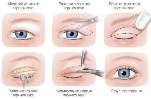 Схема операции по удалению жировых отложений на верхнем веке