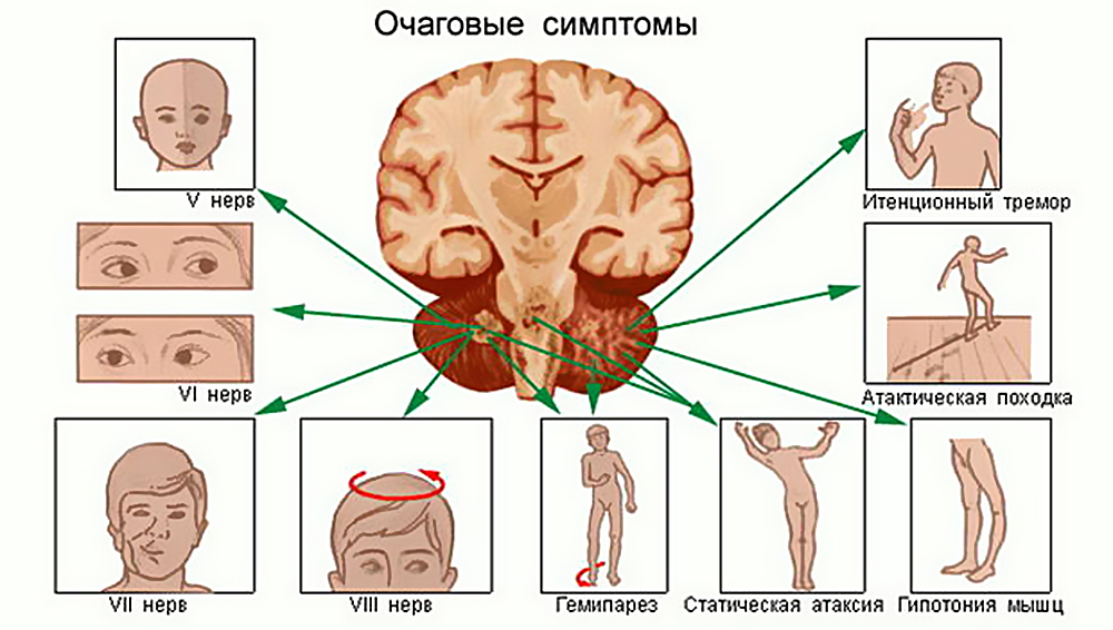 Опухоль головного мозга картинки