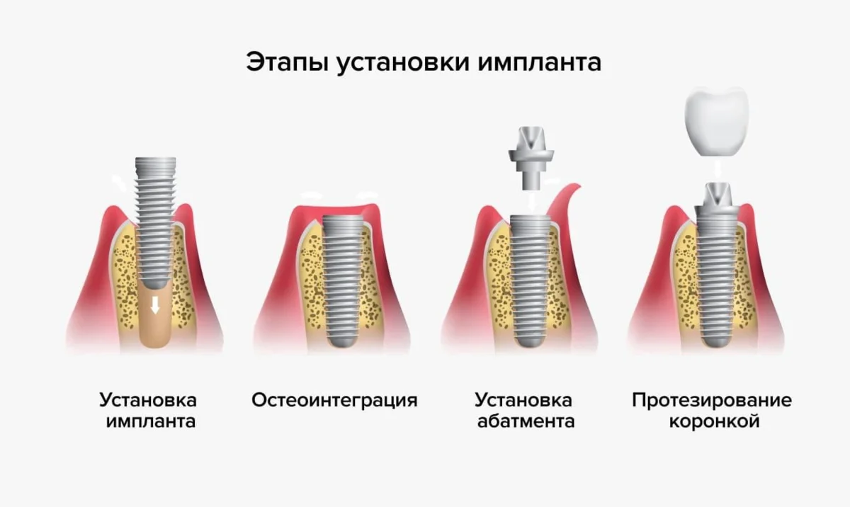 Имплантация зубов, мой опыт. Больно ли ставить имплант? 🦷 | Растём вместе  с детьми. Учу, играю, развиваю. 🤗 | Дзен