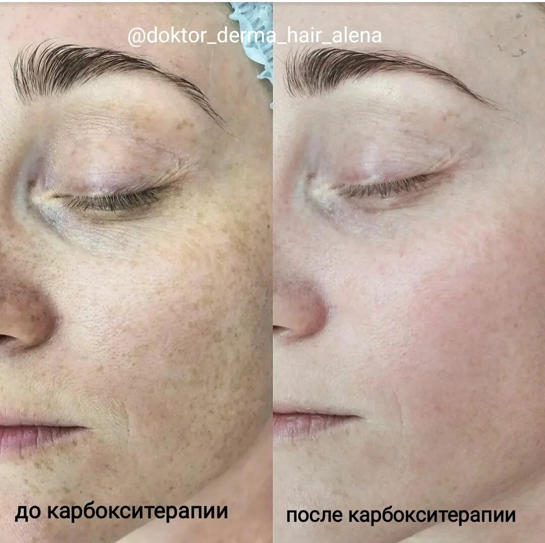 Что такое карбокситерапия для лица в косметологииКосметологи говорят, что карбокситерапия — одна из самых безопасных и при этом эффективных процедур. С помощью гелей, масок или инъекций кожу насыщают углекислым газом (СО2), который заставляет кровь отдавать кислород клеткам и тканям. В биохимии этот процесс известен как эффект Вериго-Бора (можете загадочно сообщить об этом своему молодому человеку, если вдруг он будет отговаривать вас от похода в салон). То есть, по сути, речь идет о стимуляции естественных физиологических процессов — в результате кожа начинает «дышать» и выглядит лучше, свежее, моложе.При безынъекционной (то есть когда уколы не делаются) карбокситерапии ощущения и вовсе «курортные». Возможно небольшое жжение, которое пройдет в течение первых минуты-двух после нанесения состава.Небольшой дискомфорт можно перенести, если знать, что процедура поможет:🧚‍♀️устранить шрамы и постакне;🧚‍♀️осветлить пигментные пятна;🧚‍♀️разгладить морщины;🧚‍♀️убрать отечность и темные круги под глазами;🧚‍♀️выровнять цвет лица;🧚‍♀️повысить упругость и эластичность кожи;🧚‍♀️скорректировать овал лица;🧚‍♀️убрать или хотя бы уменьшить второй подбородок;🧚‍♀️избавить от прыщей, акне и комедонов;🧚‍♀️«оживить» дряблую, увядающую кожу.Противопоказаний к неинвазивной карбокситерапии почти нет — ее можно делать даже во время беременности и кормления грудью. #карбокситерария#мезотерапия#ботокс#космртолог#спб#жк#балтийская жемчужина#красносельский #ленинский проспект#врач
