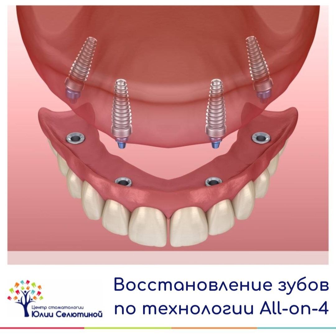 Восстановление зубов по технологии All-on-4 | Юлия Селютина | Дзен
