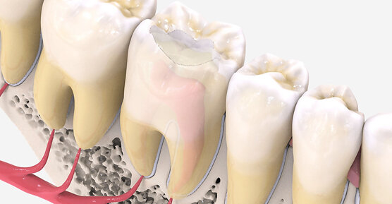 СодержаниеКогда ставят временную пломбу?
Какие материалы используют?
Как долго можно ходить с временной пломбой?
