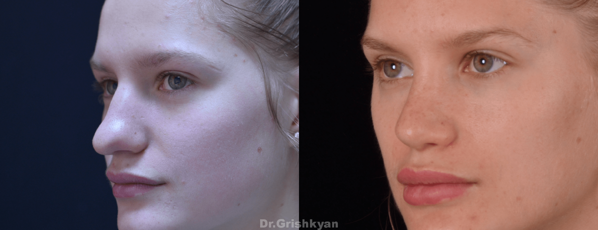 Фото до и после ринопластики носа. Фото с сайта Д.Р. Гришкяна. Имеются противопоказания, требуется консультация специалиста