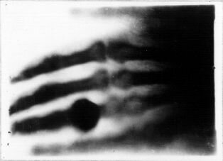 Первый рентгеновский снимок — кисть руки жены Рентгена — Анны Берты Людвиг 22 декабря 1895 года