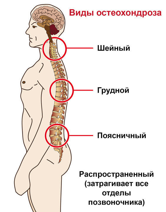 Остеохондроз позвоночника. Стадии остеохондроза. Остеохондроз позвоночника схема. Остеохондроз шейного отдела.