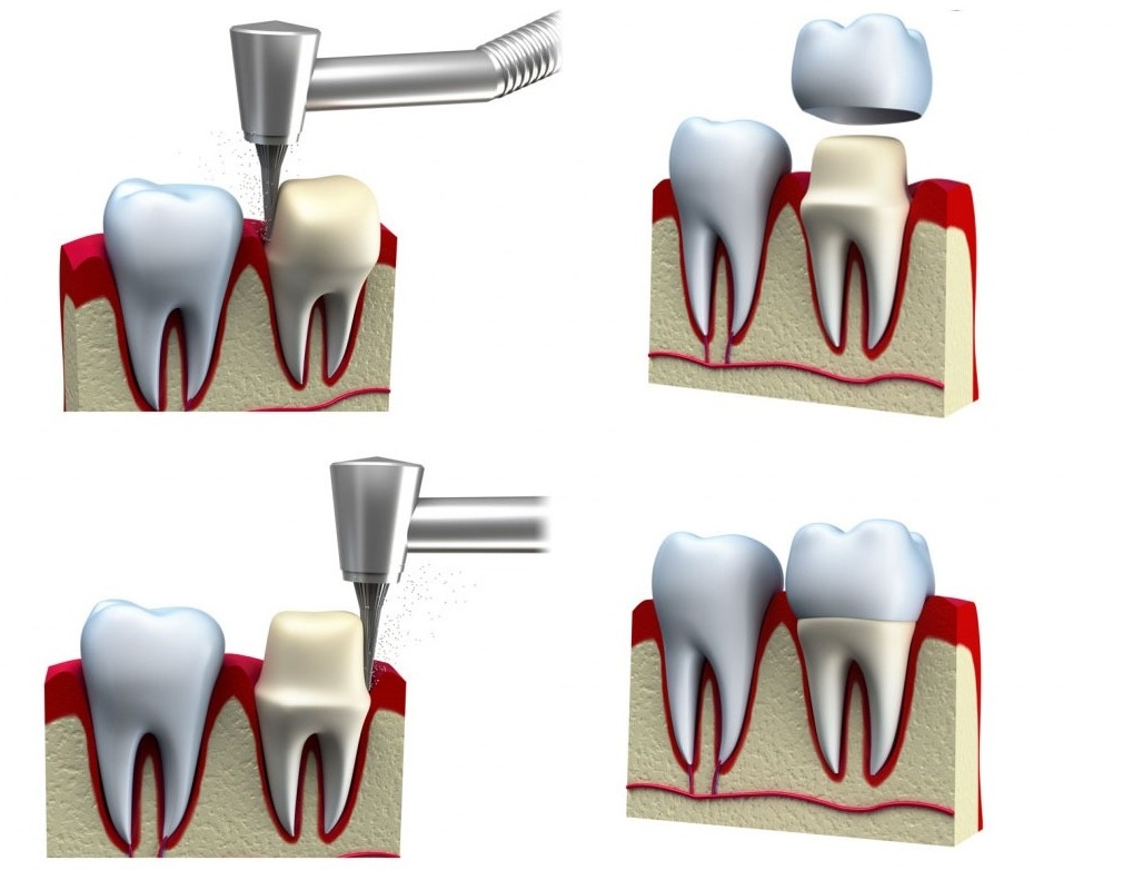 Болит зуб под коронкой — причины, что делать, как снять зубную боль