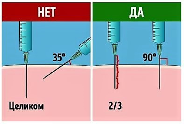 Как правильно делать внутримышечный укол?