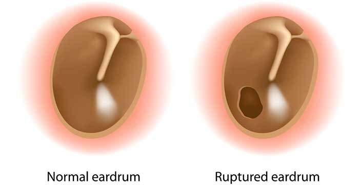 Симптомы перфорации барабанной перепонки