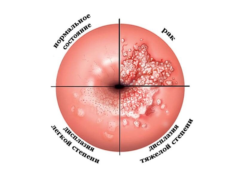 Фоновые и предраковые заболевания шейки матки