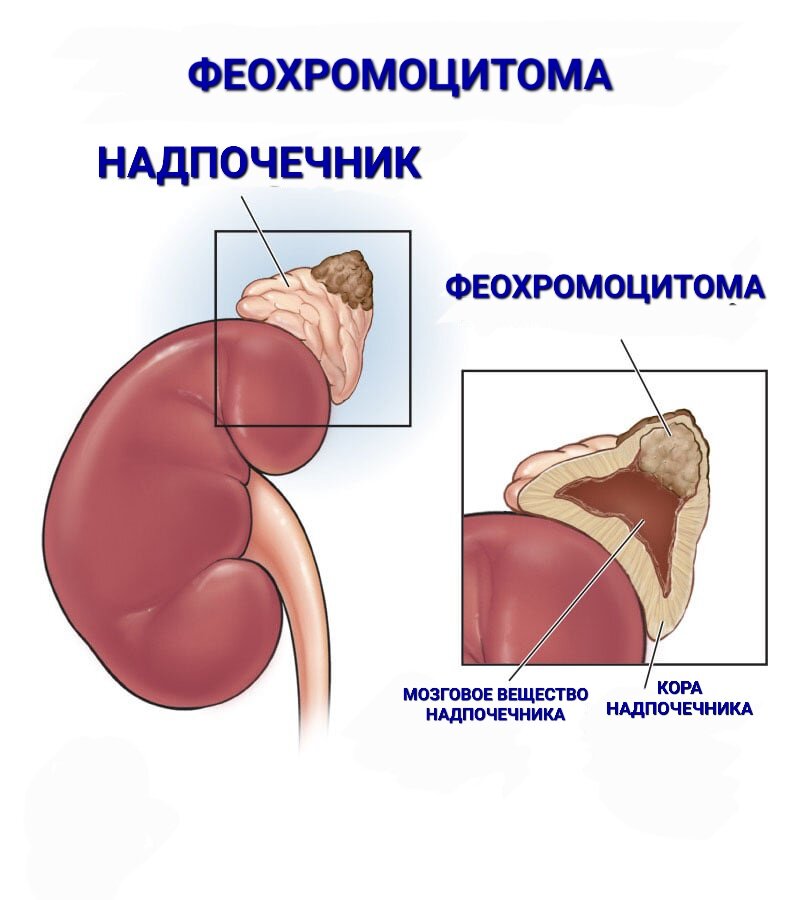 Феохромоцитома план обследования