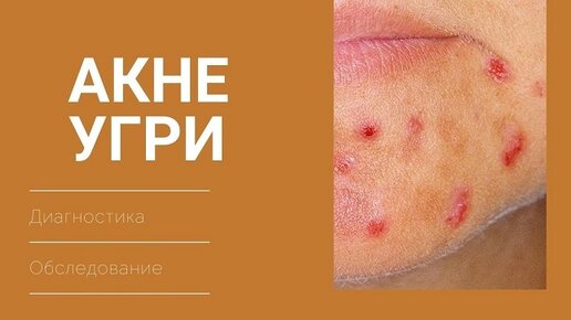 Угри (акне). Часть 2. Диагностика и необходимое обследование.