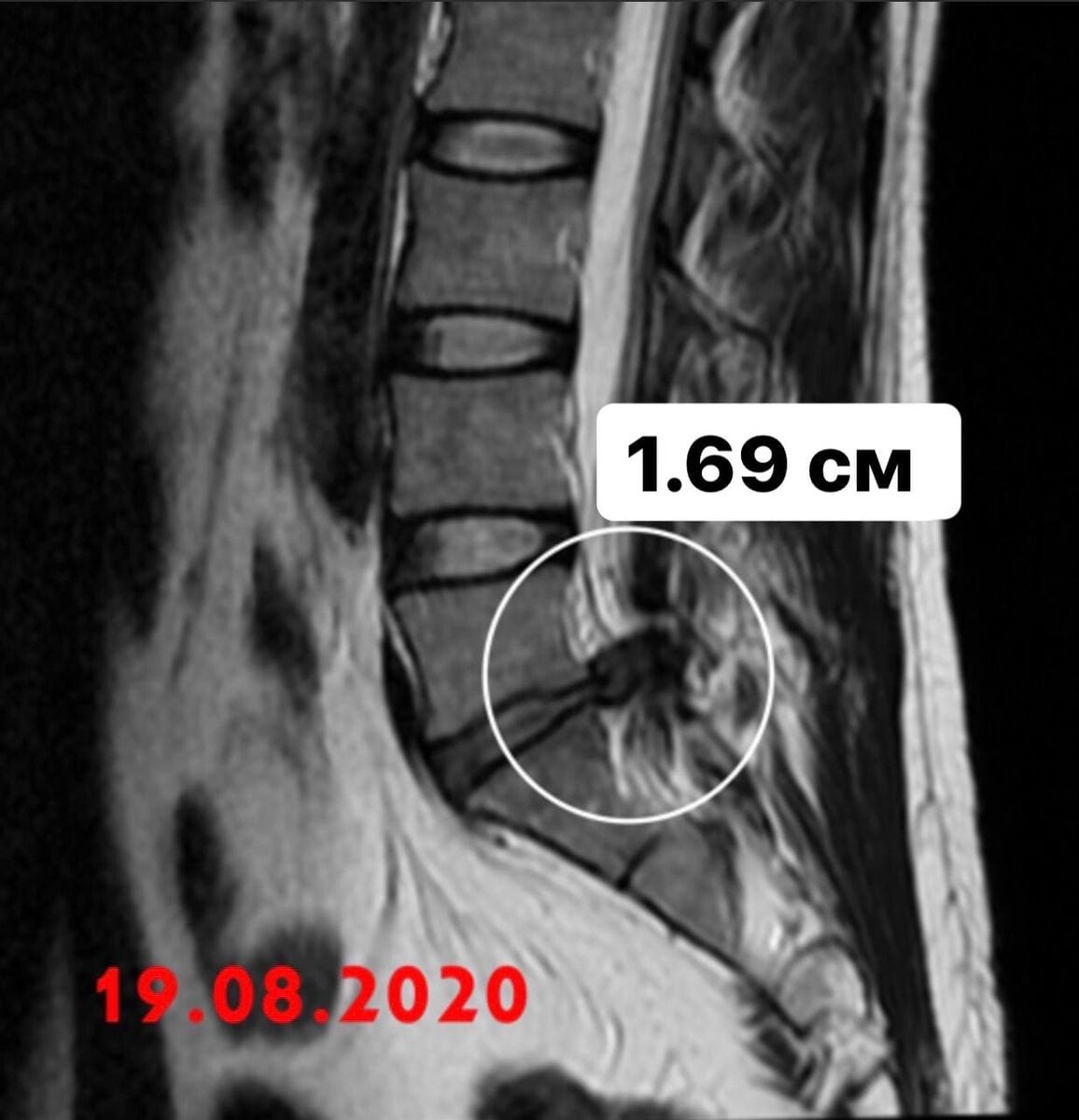 Грыжа позвоночника l 5. Грыжа диска l5-s1 0.5см. Межпозвоночная грыжа l5-s1.