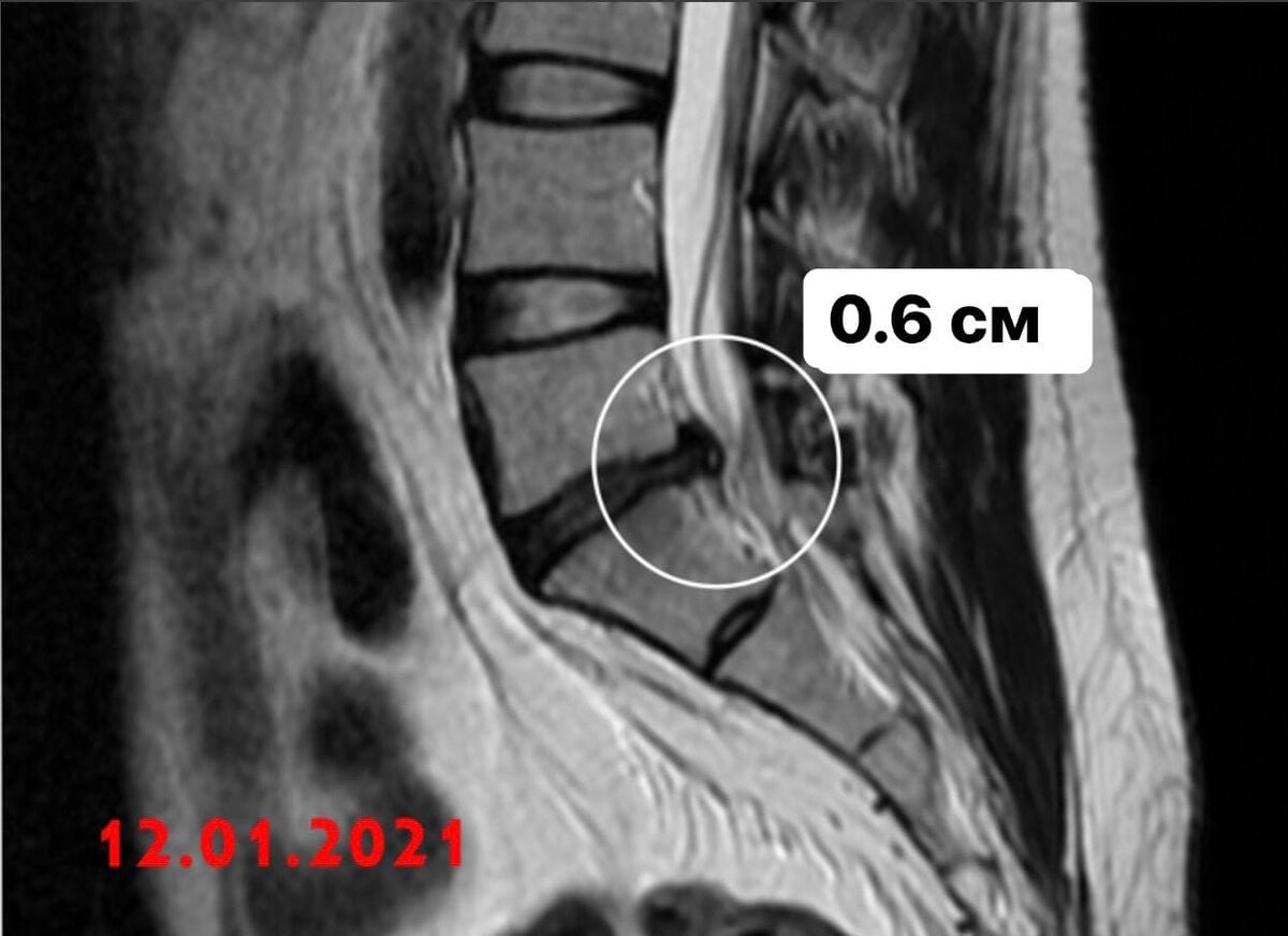 МРТ от января - грыжа 0.6 см