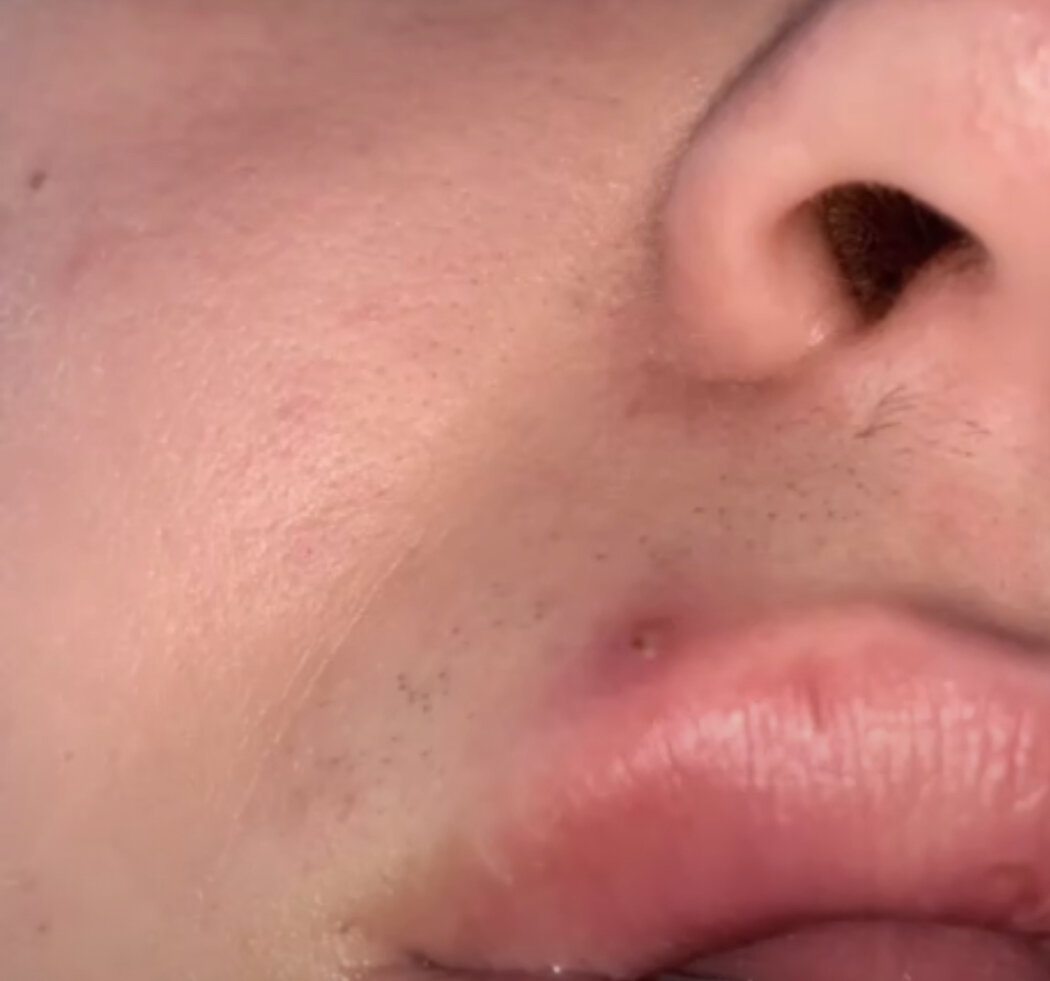 Вот такой прыщ появился над губой. Так он выглядел изначально.