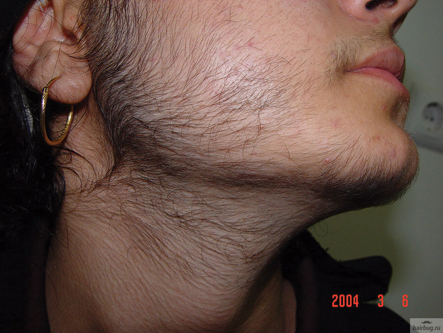 В данном случае гипертрихоз вызван фотоэпиляцией, но ятрогенный гипертрихоз может выглядеть так же впечатляюще.