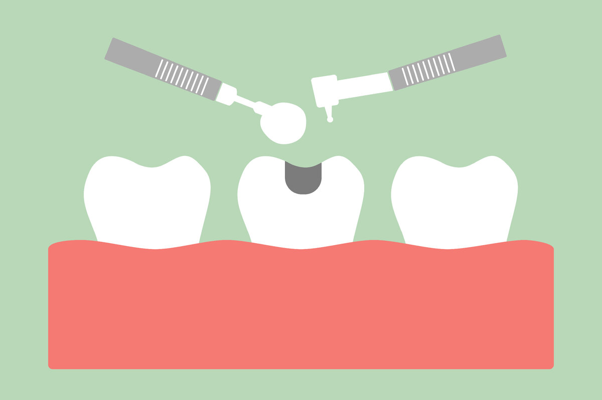 Сталкивались ли вы с тем, что после лечения врач говорит о том, что зуб рекомендуется покрыть коронкой? Объяснял ли он, почему это нужно сделать, а не оставлять зуб с пломбой?