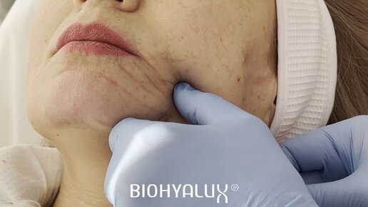 Descargar video: Векторный лифтинг и коррекция морщин скорби препаратом BioHyalux Deep Dermis