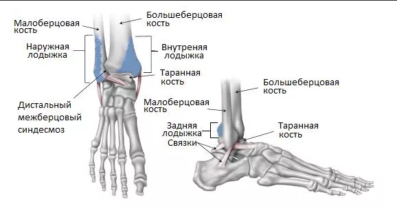 Перелом лодыжки