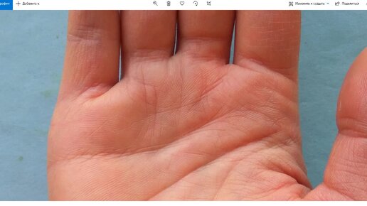 Вывих пальца на руке: причины, симптомы, методы лечения и реабилитации
