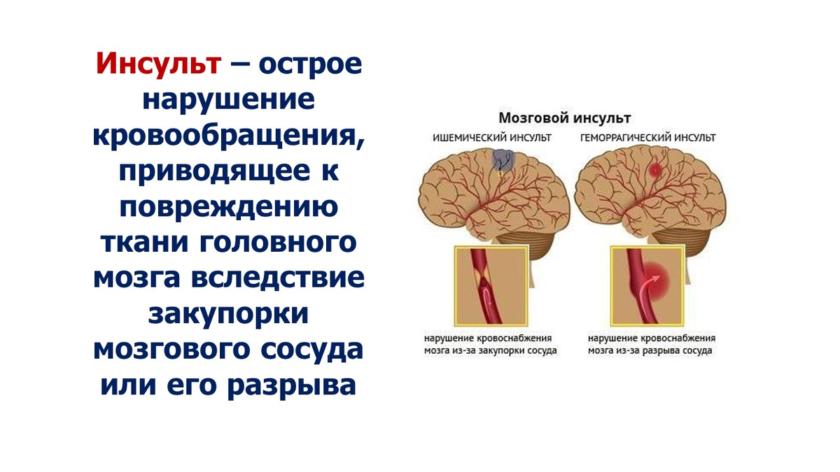 Инсульт что это такое и причины. Инсульт острое нарушение мозгового кровообращения. Факторы риска нарушения мозгового кровообращения. Факторы риска острого нарушения мозгового кровообращения.