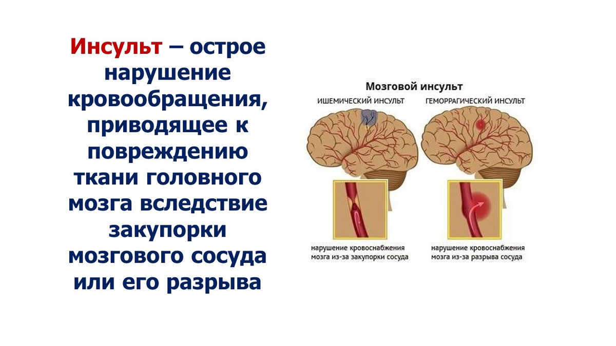 Ишемический инсульт у мужчин. Инсульт острое нарушение мозгового кровообращения. Факторы риска нарушения мозгового кровообращения. Факторы риска острого нарушения мозгового кровообращения.