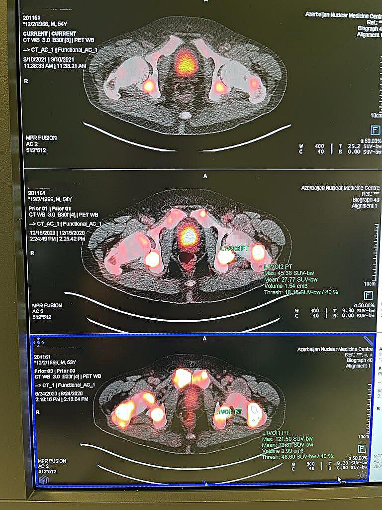 Динамика результатов ПЭТ-КТ исследований с PSMA-617, меченого изотопом 68Ga, контрольных очагов в тазобедренных суставах в сравнение. До начала лечения и после первого, и второго курсов терапий по протоколу Тандем. На свечение в центре снимка не обращаем внимание по причине того, что это физиологическое накопление рфп в мочевом пузыре.